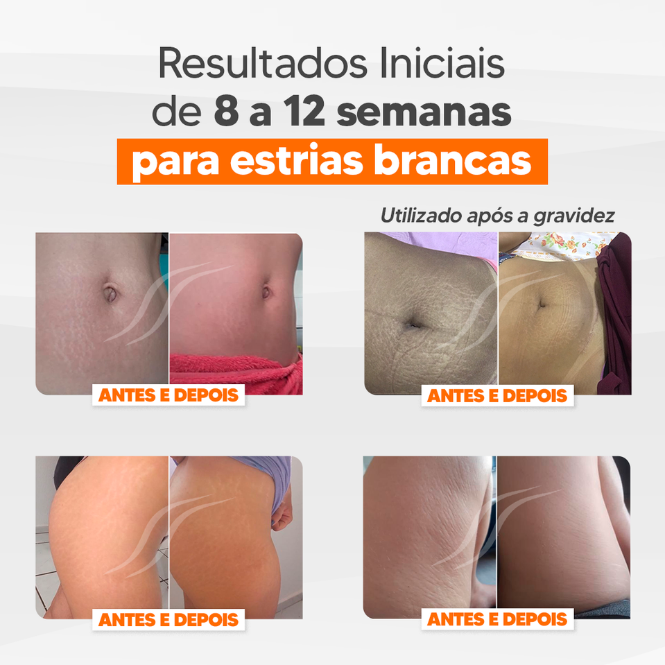 Cicatrissim Stretch Marks Cream - 1 Year Treatment