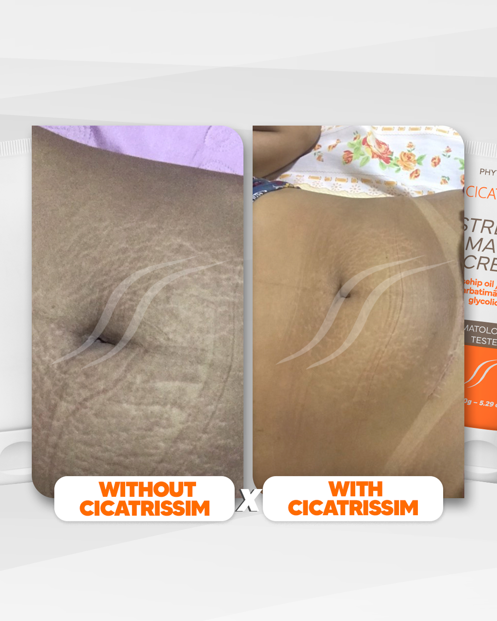 Cicatrissim Stretch Mark Cream - 2-Pack Bundle