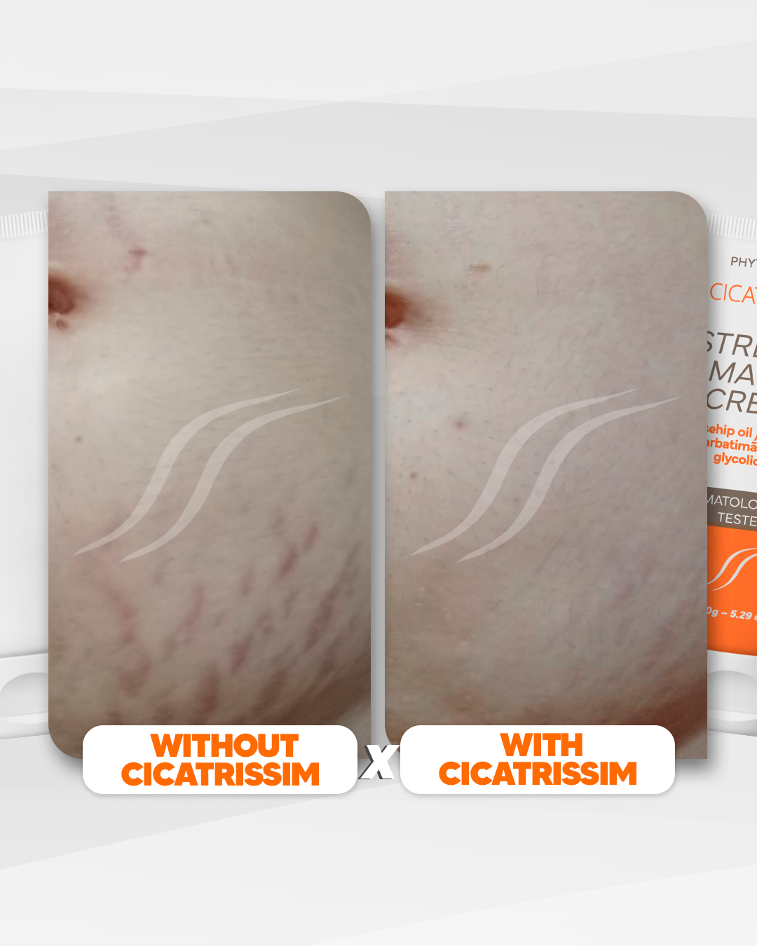Cicatrissim - Crema para las estrías - Tratamiento de 6 meses 