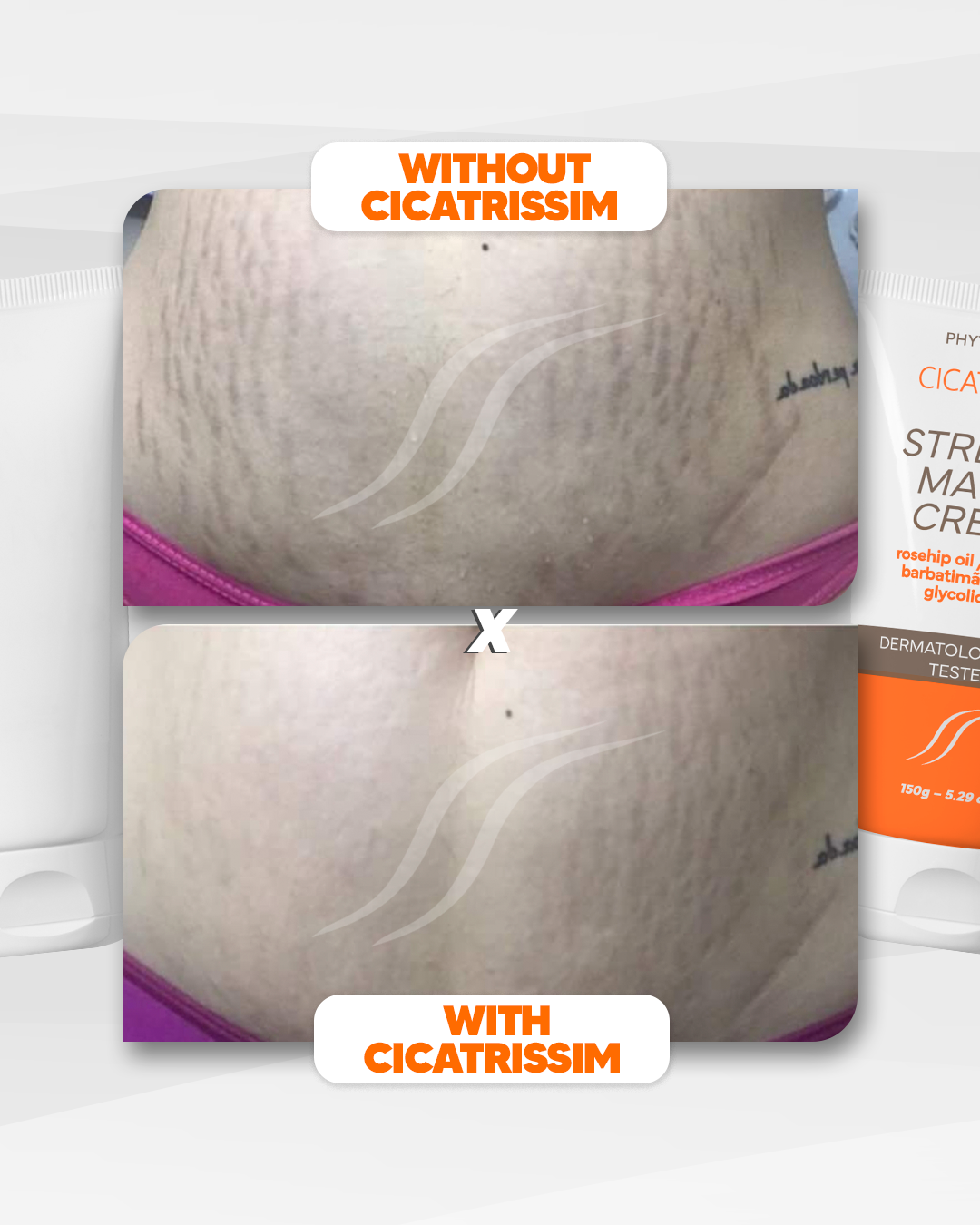 Cicatrissim™ Advanced Stretch Mark Treatment