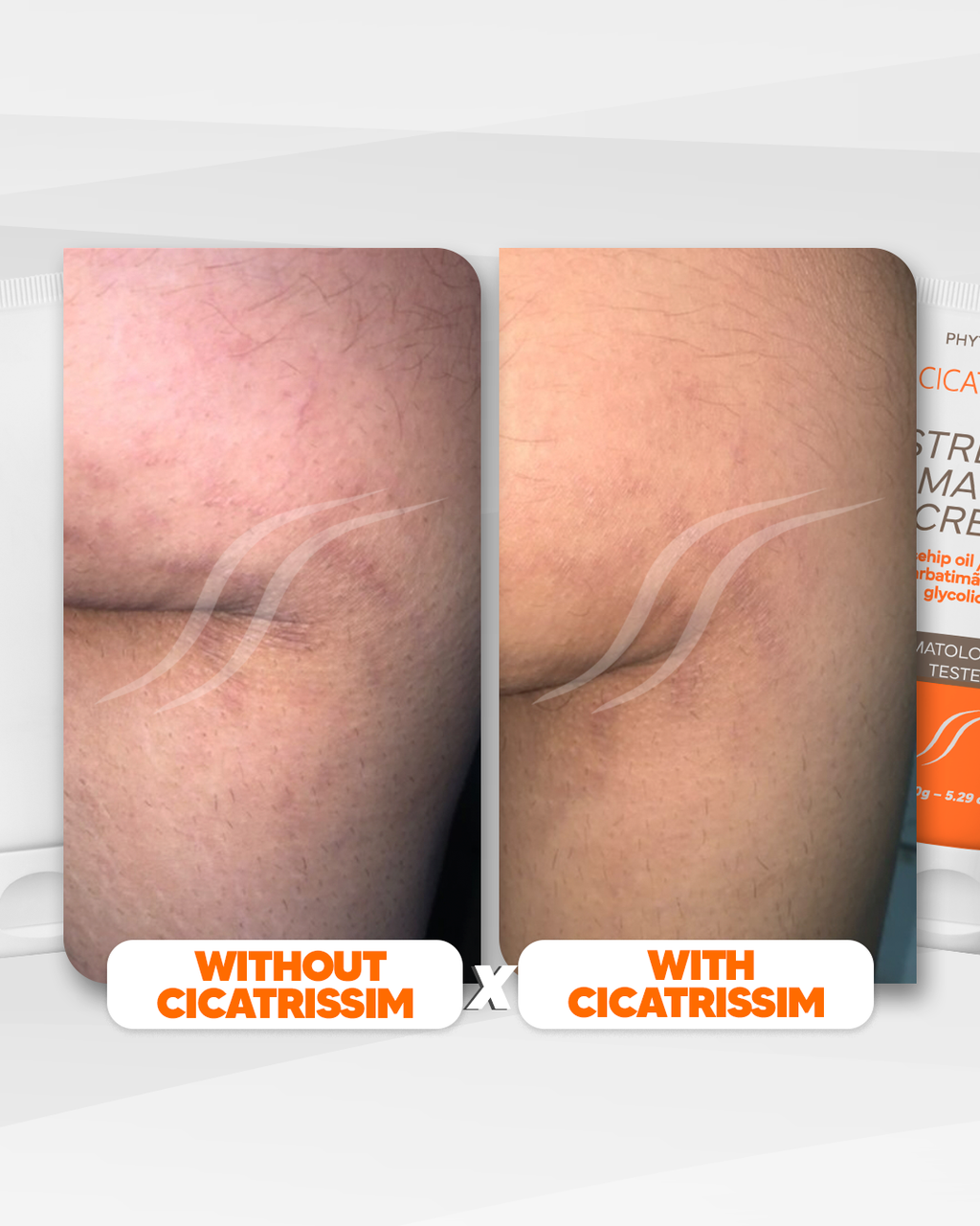 Cicatrissim Stretch Mark Cream - 2-Pack Bundle