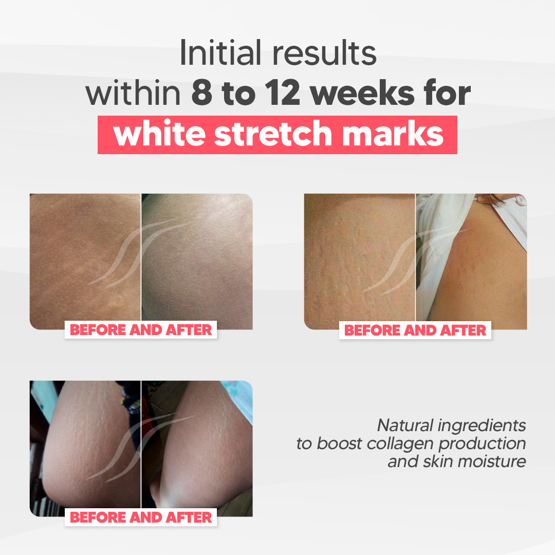 CicatrissimWhite - WHITE Stretch Marks Cream