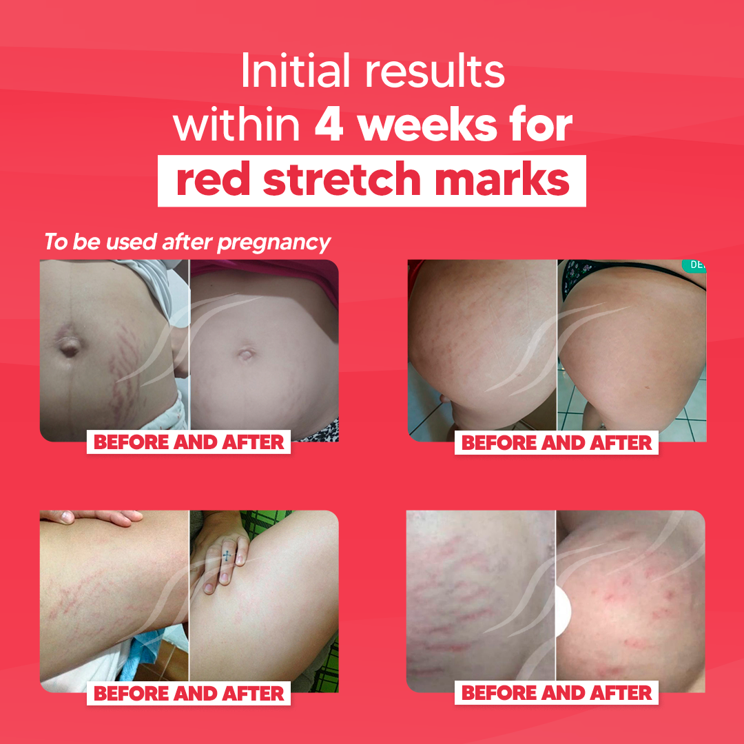 CicatrissimRed - RED Stretch Marks Cream